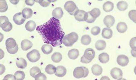15 A neutrophil myelocyte showing a smaller cell than a promyelocyte with some condensation of nuclear chromatin and no visible nucleolus.