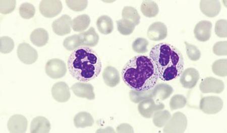 The Blood Film and Count 15 Fig. 1.16 A neutrophil metamyelocyte between two segmented neutrophils. The nucleus is indented. Metamyelocytes Small numbers of neutrophil metamyelocytes (Fig. 1.16) are present in the blood of healthy subjects.