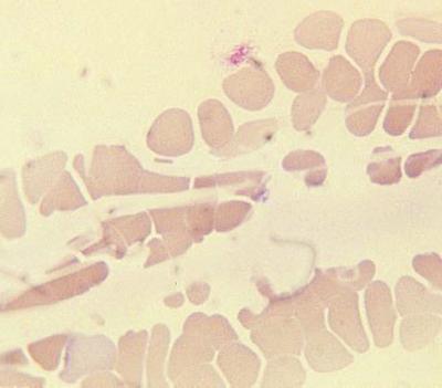 The Blood Film and Count 27 Fig. 1.22 Fibrin strands passing between and over red cells. Fig. 1.23 Platelet satellitism.