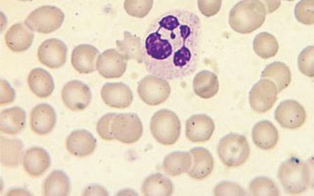 The Blood Film and Count 7 Fig. 1.6 A normal neutrophil from a female showing a nucleus with four lobes and a drumstick. Fig. 1.7 A normal bilobed eosinophil.
