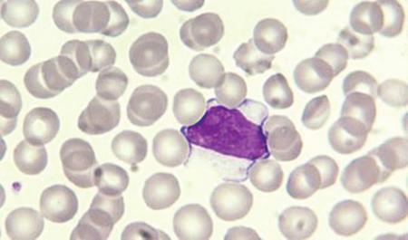The Blood Film and Count 9 Some lymphocytes have a variable number of azurophilic ( pinkish purple) granules.