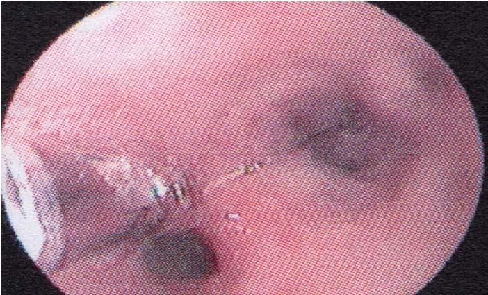 2. Case Presentation A 44-year-old woman with a history of cough, sputum, shortness of breath that lasted for about 6 months, and recent increase in complaints indicated that she didn t have any