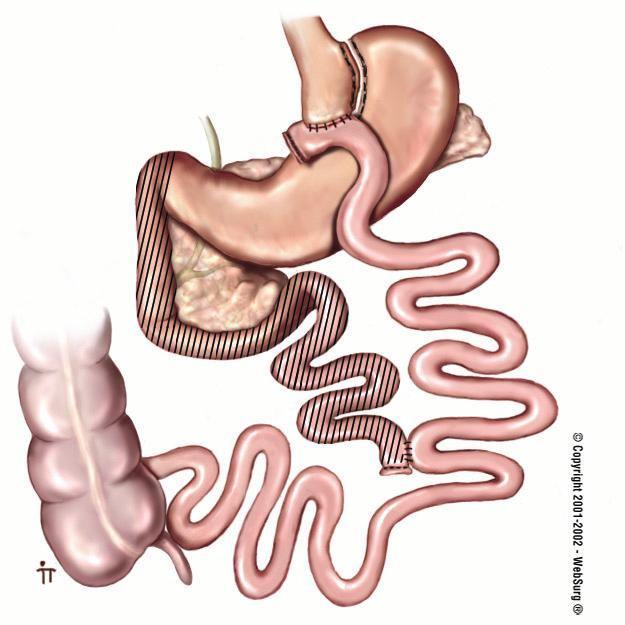 The Hindgut Theory The more rapid delivery of undigested nutrients to the distal bowel upregulates the