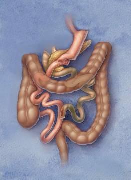 al, Bariatric surgery, a systematic review and metaanalysis,