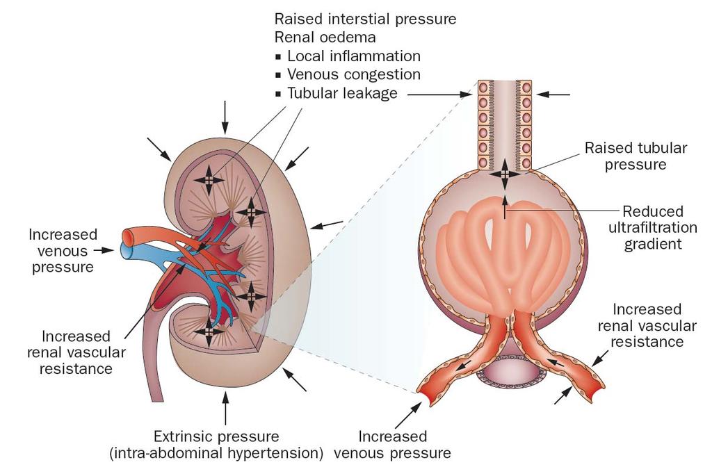 Venous Congestion Glomerular filtration pressure = Renal perfusion pr.