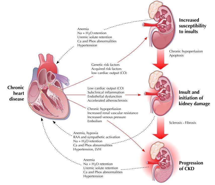 CardioRenal Syndrome