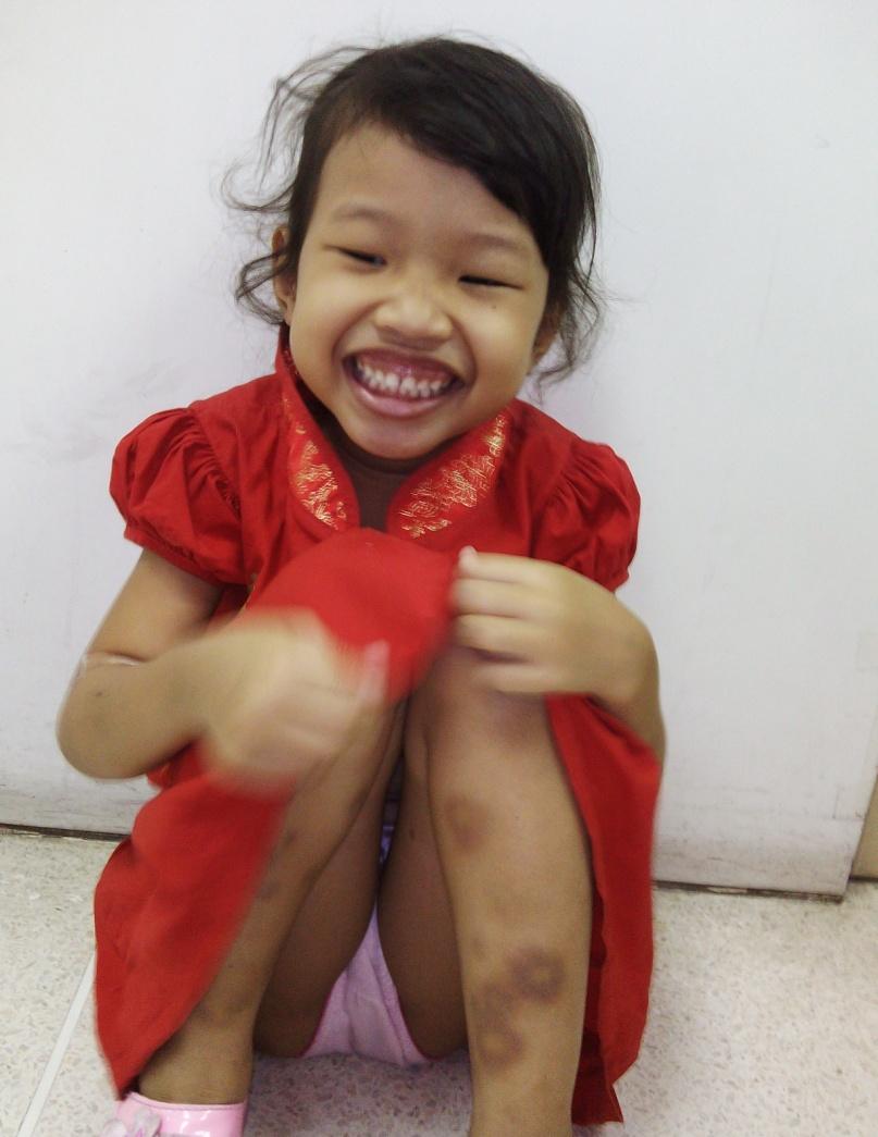 Case study A 5-year-old girl presents with multiple large ecchymoses on both arms and legs.
