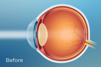A small incision is made on the side of the cornea, the clear, dome-shaped surface that covers the front of the eye. 2. Manual Small Incision cataract surgery (MSICS). 3.