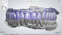 9: The teeth were prepared for full-coverage restorations, retracted and scanned, after which the patient took a break while remaining in the dental office. Fig.