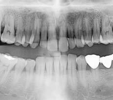 left of 1mm. A labioversion existed on the left lateral incisor and there was a recessed gingival line (Fig. 2A).