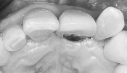 Clinical and histologic evaluation of bone replacement grafts in the treatment of localized alveolar ridge defects. Part 2: bioactive glass particulate. Int J Periodontics Restorative Dent.