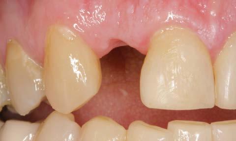 remodeling and natural soft-tissue appearance following tooth
