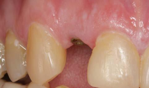 periapical infection and horizontal fracture.