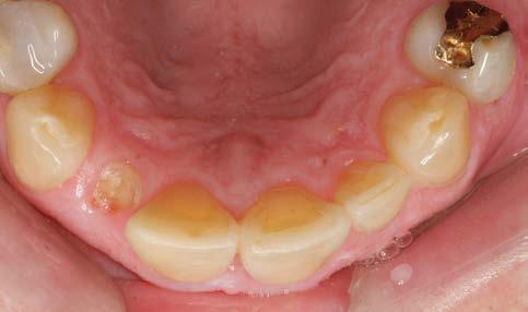 3 Occlusal view of the clinical situation prior to extraction of