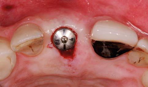 incisor. Implant visible through mucosa due to thin biotype.