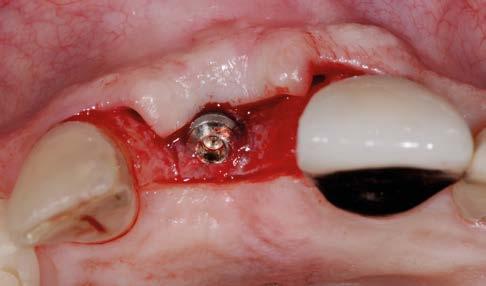 and occlusal area.