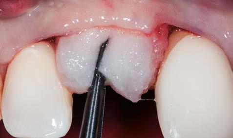 soft-tissue around a single implant in the