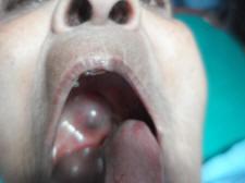 On examination, there was a swelling measuring 4 cm by 3 cm on the soft palate to the left of midline. The mass was reaching up to the upper pole of the left tonsil.