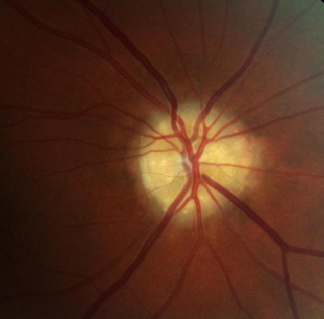 Case 2 - Right Optic Nerve Head Drusen (ONHD) A 41 year old female was referred by her optometrist for a workup for unilateral optic disc drusen, OCT, and visual field changes.