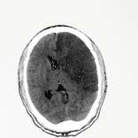 You need a cause! Clinical Exam Determining brain death in a patient with repeatedly normal CT scan is never acceptable.