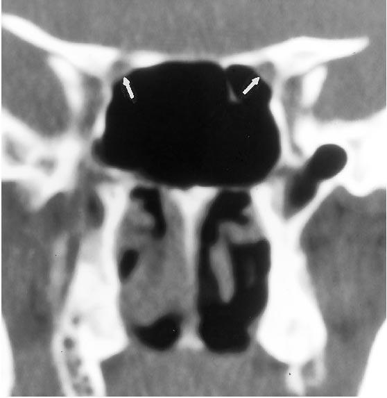 The optic canal (arrows in B and C) is adjacent to the sphenoidal sinus but does not indent the wall of the