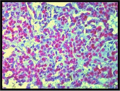 negative. Figure 5: An example of strong ER positive staining of almost 98% of the nuclei.