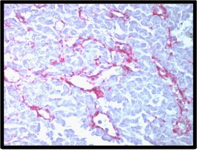 Figure 2: Smooth muscle actin highlighting the myoepithelial layer of benign ducts. Figure 3: Negative SMA immunostain in a case of invasive carcinoma.