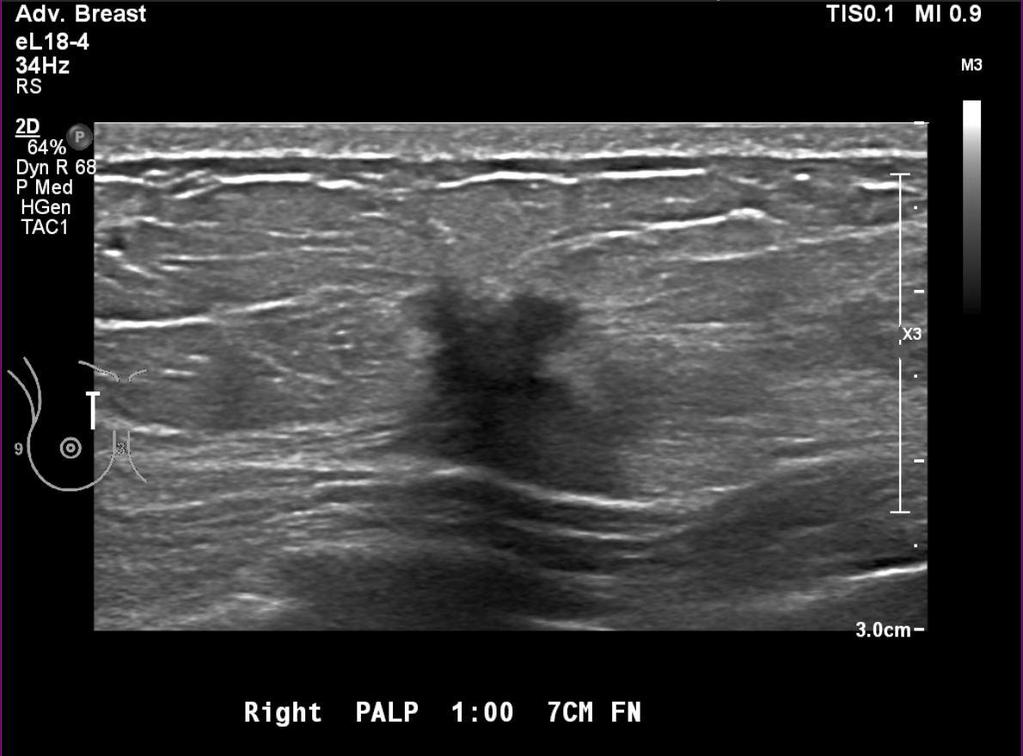 Ultrasound Focused sonography of the right breast over palpable abnormality demonstrates an irregular