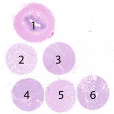 Assessment Run 43 205 Sal-like protein 4 (SALL4) The slide to be stained for SALL4 comprised:. Appendix, 2. Testis, 3. Renal clear cell carcinoma, 4. Seminoma, 5.