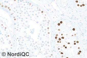 The neoplastic cells are demonstrated, but the intensity is reduced. Fig. 3a Optimal staining for SALL4 of the intratubular germ cell neoplasia using same protocol as in Figs. a and 2a.