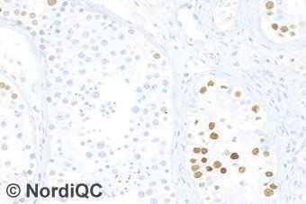 No background staining is seen. Fig. 3b Staining for SALL4 of the intratubular germ cell neoplasia using same protocol as in Figs. b and 2b. same field as in Fig. 3a.