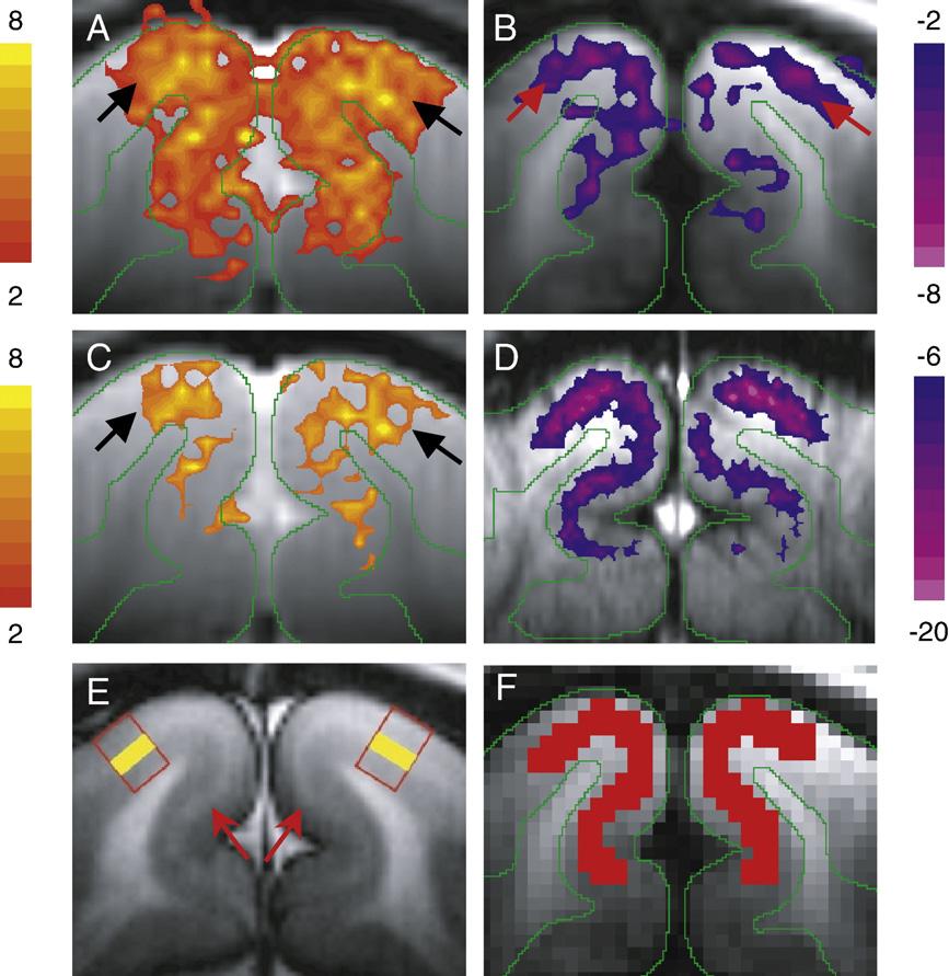 T. Jin, S.-G. Kim / NeuroImage 40 (2008) 59 67 63 Fig. 3. Functional maps overlaid on baseline EPI images (A D) and demarcation of ROIs (E F).
