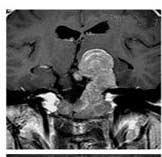 Cabergoline in Giant Prolactinoma 877 Case 1 Case 2 Case 6 Case 10 DISCUSSION 6 mo 5 mo 6 mo 7 mo 16 mo 17 mo 16 mo 30 mo Fig. 2. Serial follow-up of gadolinium-enhanced T1 weighted magnetic resonance imaging before and during cabergoline treatment.