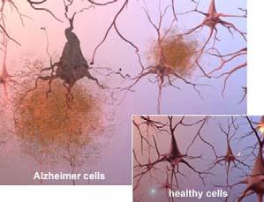 Traditional view Amyloid plaque damages brain cells