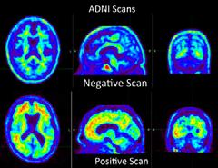 Detecting the biomarkers Amyloid PET Evidence for Aβ pathophysiology Detects amyloid