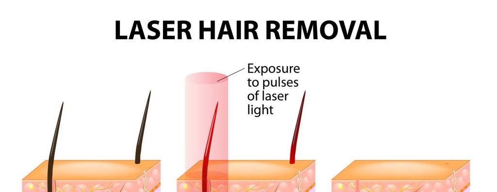Figure 3: Laser hair removal schematically explained. Diode lasers operating at 760 nm dominate the hair removal market.
