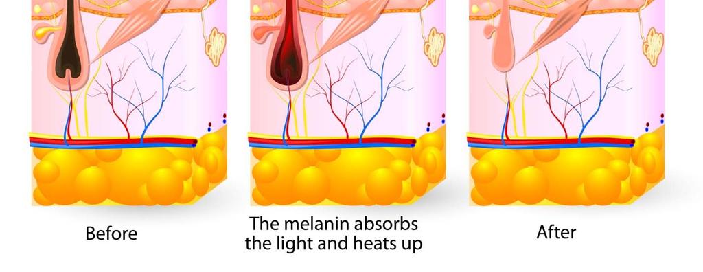 However, managing the trade-off between follicle and dermis damage becomes more difficult at this wavelength in darker-skinned patients due to the increased melanin in the skin.