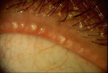 Meibomian Gland Dysfunction and Ocular Surface Disease ABNORMAL NORMAL http://www.rheineyesolutions.com/wp-content/uploads/2013/03/rhein-normal.