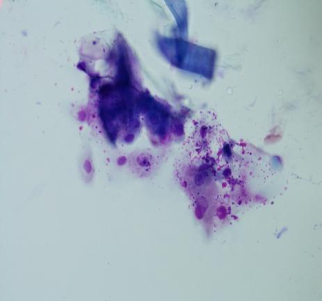 margins and meibum: blood, chocolate and Sabouraud agar Gram stain of lid margins and meibum Cytology of