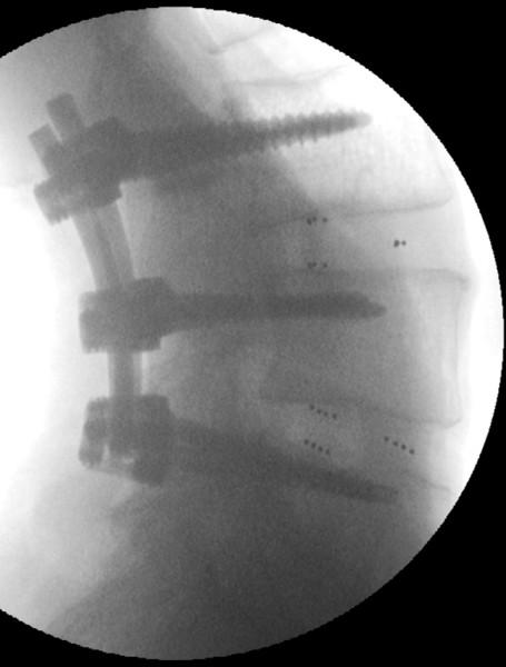 After implantation of the InterFuse S device is complete, release the distraction of the disc prior to permanent positioning of the pedicle screw rods, facet screws, or
