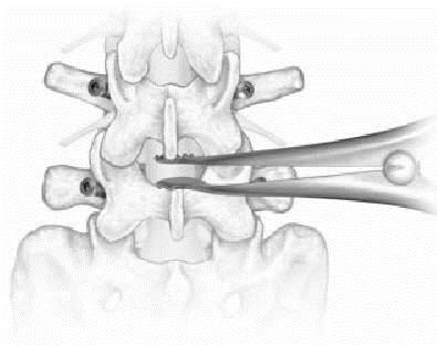 Pedicle Distraction Method Distraction can be applied between the heads of inserted pedicle screws.