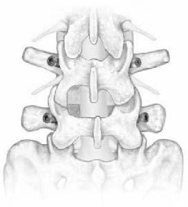 This method temporarily opens the posterior disc space and promotes increased exposure for access, decompression and delivery of the implant.