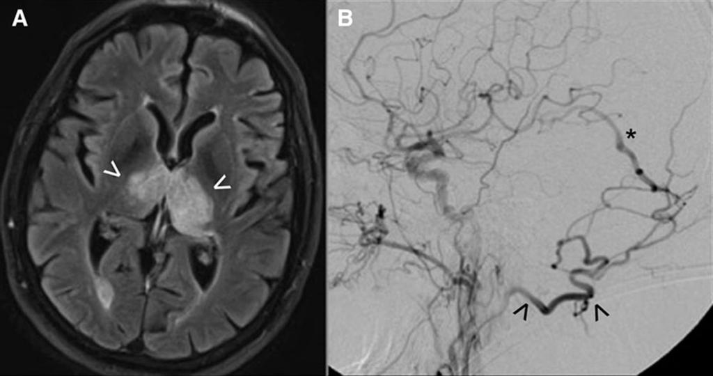 Clinical manifestations & imaging features C (A) Bithalamic edema as a result of venous hypertension in a patient with rapidly progressive dementia.