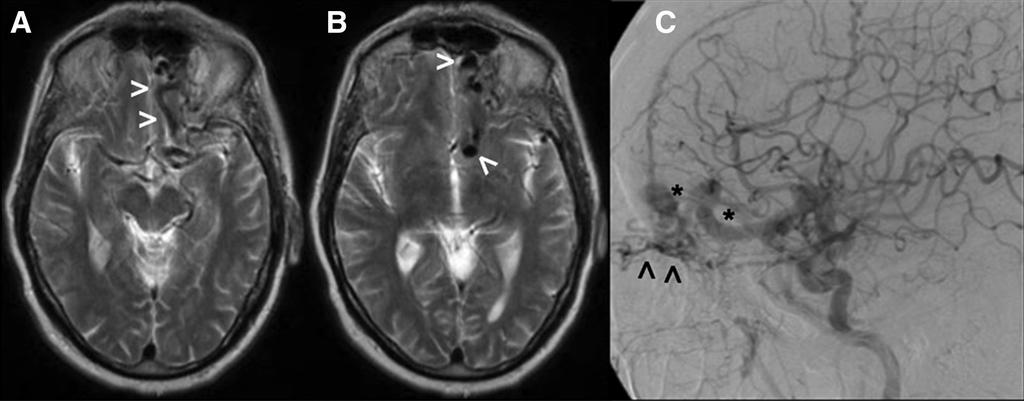 Clinical manifestations & imaging features T2-weighted MRI (A&B) showing large vascular flow voids (arrowheads) near the left anterior fossa floor.