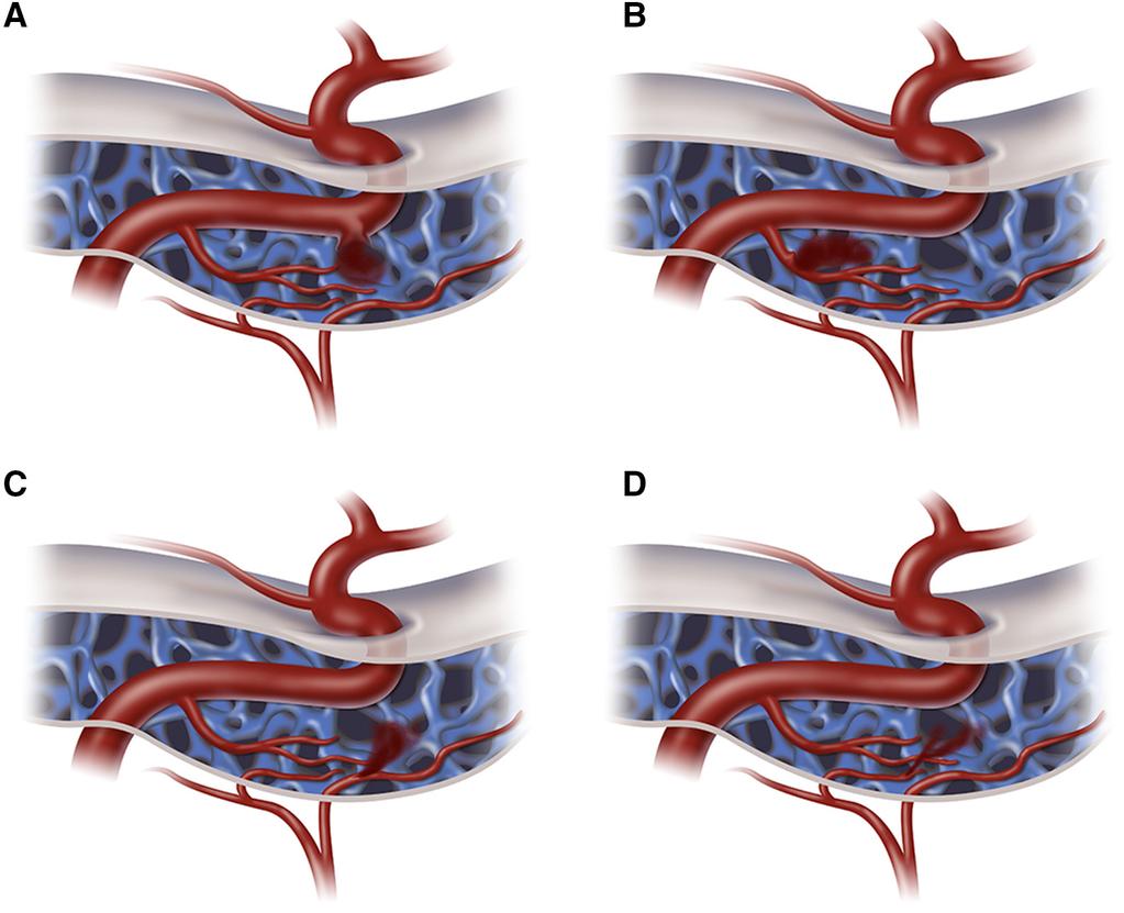 Barrow classification carotid-cavernous fistulae Carotid-cavernous fistulae: Type A: direct fistulae (high flow) between the intracavernous internal carotid artery (ICA) and the cavernous sinus (CS);