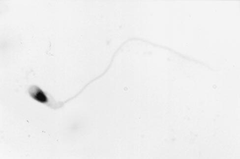 FIGURE 1 Elongated (Sd) spermatid observed in a Papanicolaoustained smear of in vitro cultured testicular cells from a man with meiotic maturation arrest with a complete absence of elongating and