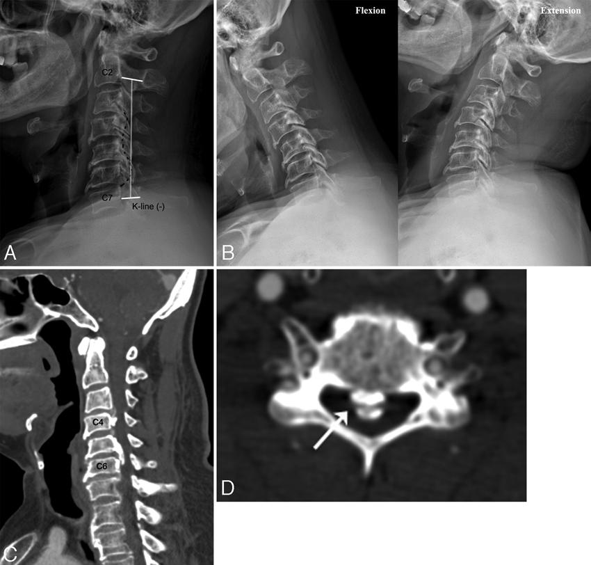 Greenstick fracture technique to correct kyphosis FIG. 1. Case 1. Images obtained in a 68-year-old man who exhibited clumsiness in both hands as well as pain with numbness in both hands for 2 3 years.