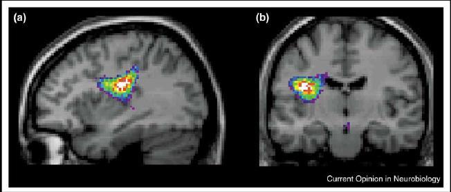 Activation of interoceptive cortex directly correlated