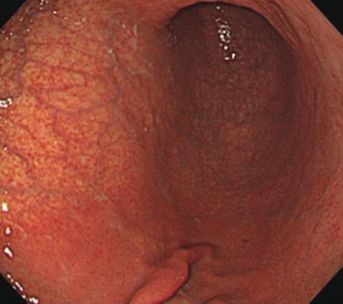 Lee SP, et al. Endoscopy and Pepsinogen Assay cessful H. pylori eradication, having significant disease(s) that should be managed promptly, or incomplete finding in any of the performed tests.