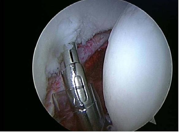 Traumatic Posterior Hip Instability and Femoroacetabular Impingement in Athletes A Figure 4. Case 1 arthroscopic photographs of suture anchor repair of posterior labral tear.